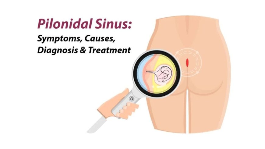 Advanced Pilonidal Treatment in Thrissur, Kerala – Dr. Raviram S.