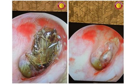 Cockroach in Ear: Dr. Purodha Prasad Saves Delhi Patient in Emergency ENT Case